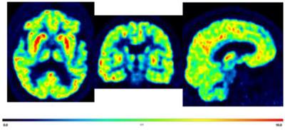 Advances in PET imaging of ischemic stroke